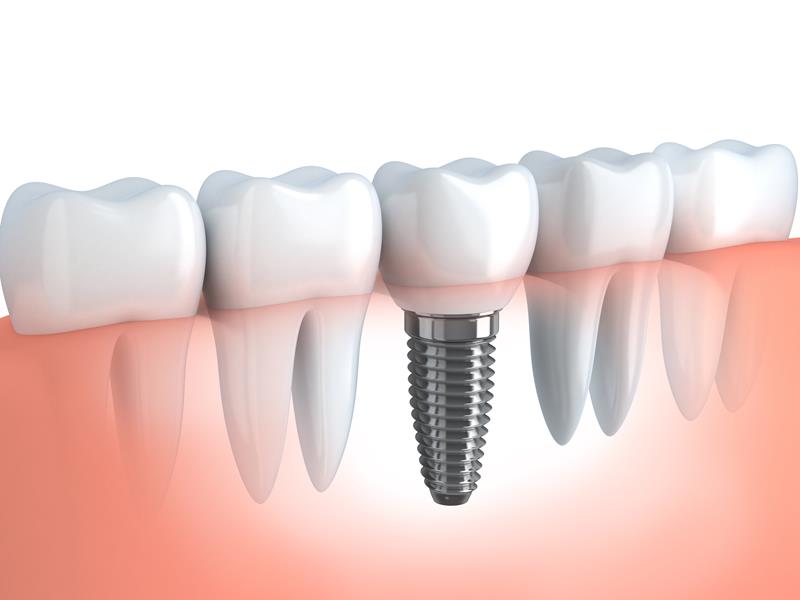 Dental Implants  Newington, CT -