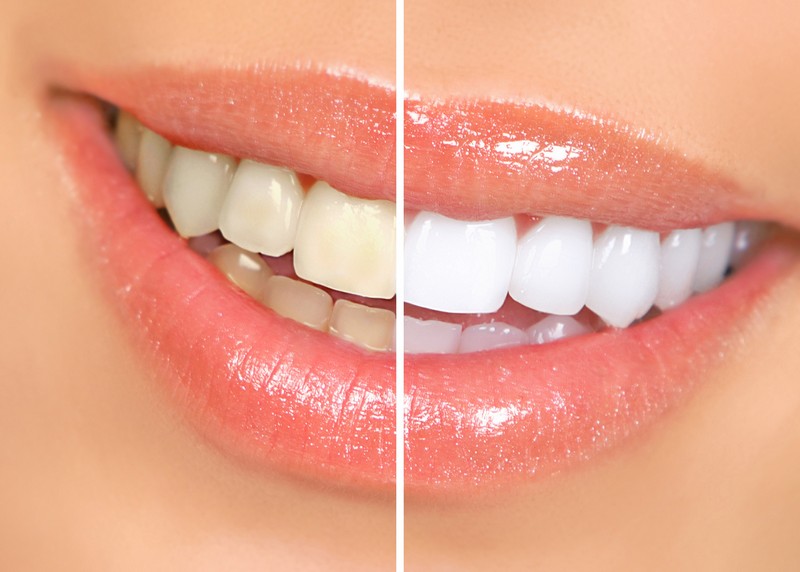 Teeth Whitening  Newington, CT -